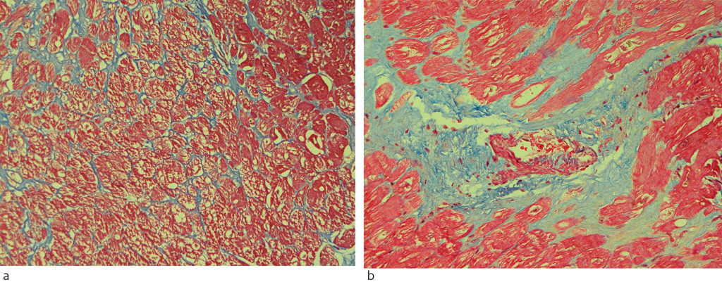Figure 4 Myocardial biopsies from patients with hypertrophic cardiomyopathy. Masson trichrome stains connective tissue blue&hellip;