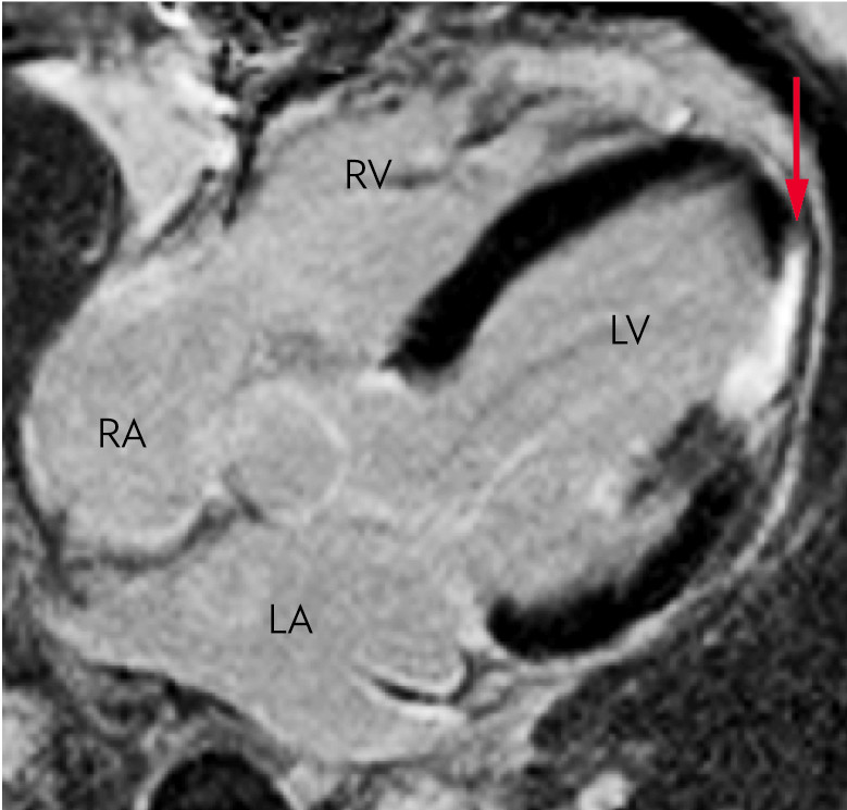 Figure 5 Cardiac MRI scan after injection of gadolinium-based contrast. The left ventricle shows increased signal (red arrow&hellip;