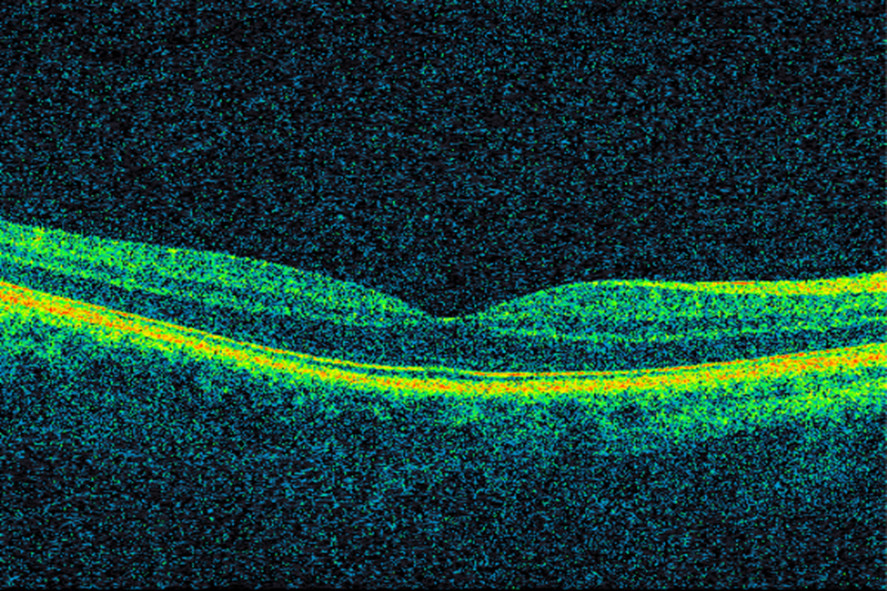 Figure 1 Optical coherence tomography (OCT) showing a normal macula. In the middle, the fovea centralis, which has the&hellip;
