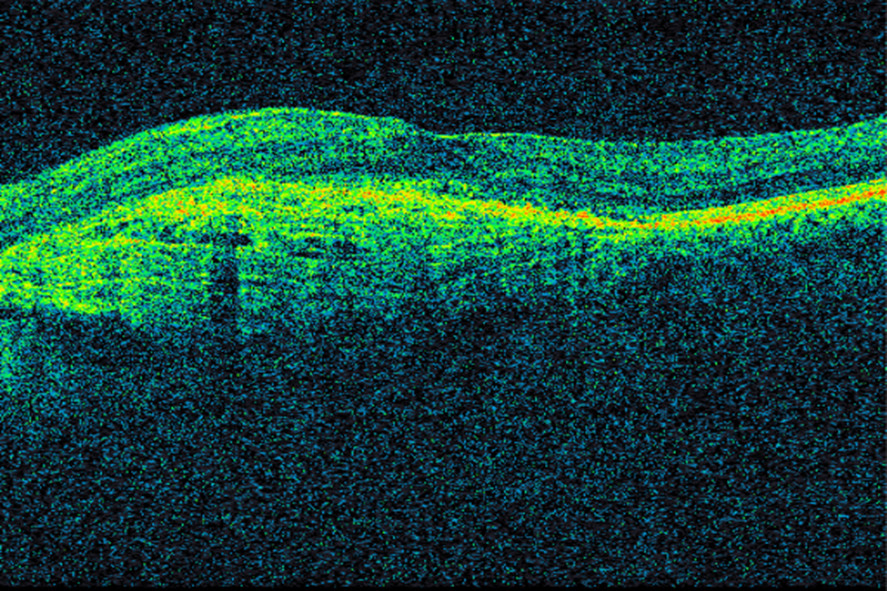 Figur 3 OCT av makula hos samme pasient tre &aring;r senere etter gjentatte anti-VEGF-injeksjoner. Det er n&aring; tiln&aelig;rmet t&oslash;rre&hellip;