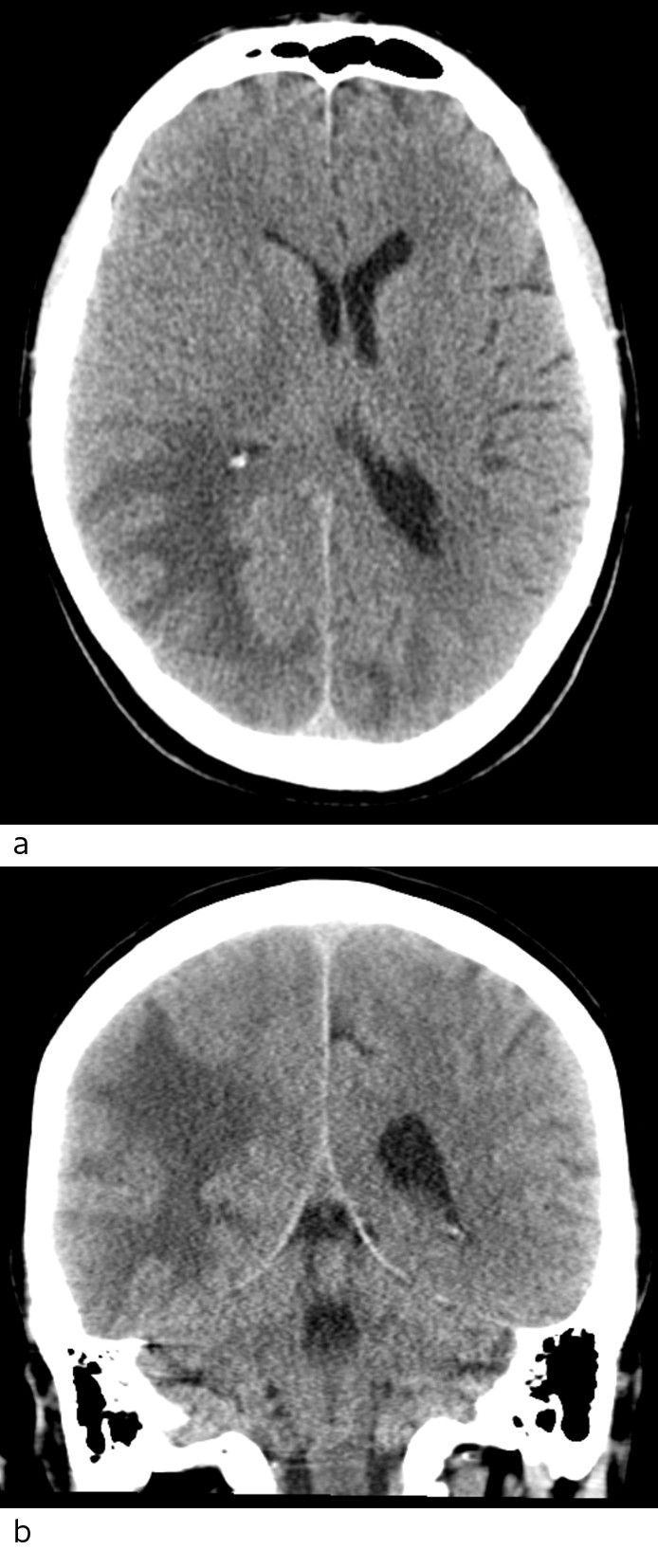Figure 1 Head CT scan axial section (a) and coronal section (b) show extensive low-density changes that may be consistent&hellip;