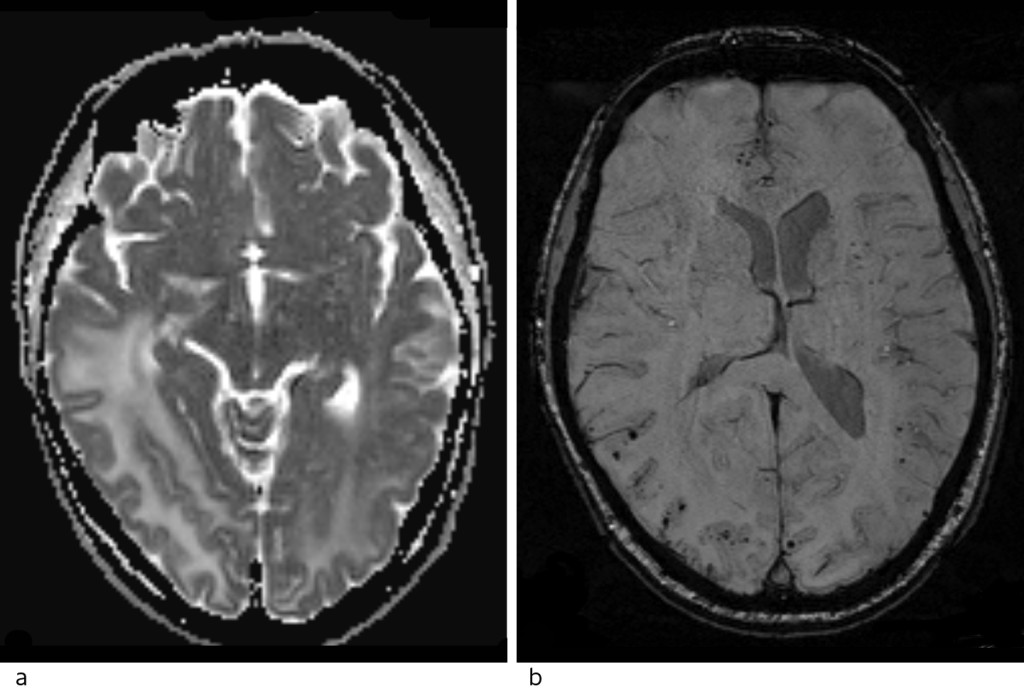 Figure 2 Head MRI. a) ADC map with high values consistent with vasogenic oedema. b) Susceptibility-weighted imaging (SWI)&hellip;
