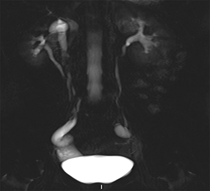 Figure 1 MRI. Coronal 50 mm thick section, T2-HASTE (Half-Fourier Acquisition Single-shot Turbo spin Echo imaging). A right&hellip;