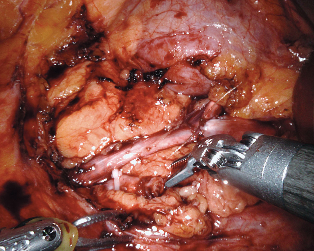 Figure 5 The anastomosis between the upper and lower collecting systems is complete.