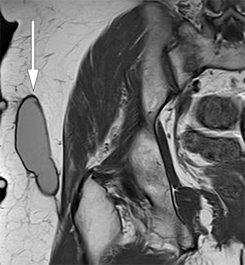 Figure 1 Coronal T1-weighted MRI of right hip. Well-defined, elongated, lenticular structure with homogeneous intermediate&hellip;