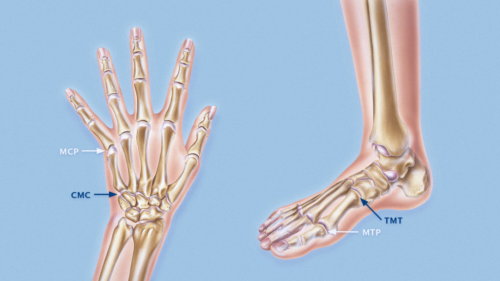 Figur 1 H&aring;nd- og fotskjelettet. Rotledd (CMC- og TMT-ledd) markert med bl&aring; pil, grunnledd (MCP- og MTP-ledd) markert med&hellip;