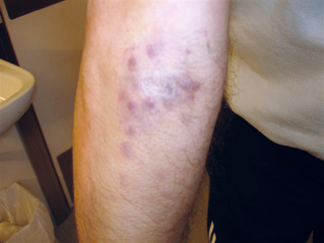 Figure 1 Photograph of the patient's forearm showing purplish nodules in the skin.