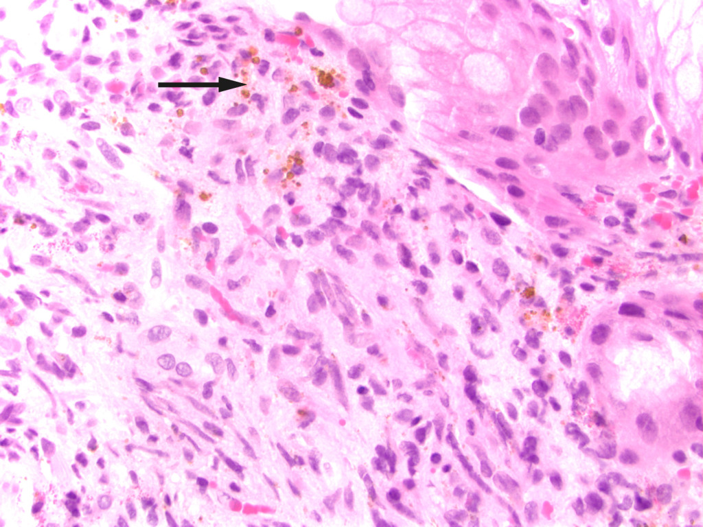 Figure 2 Biopsy from the gastric mucosa with capillary proliferation, extravasated erythrocytes and haemosiderin (arrow)&hellip;