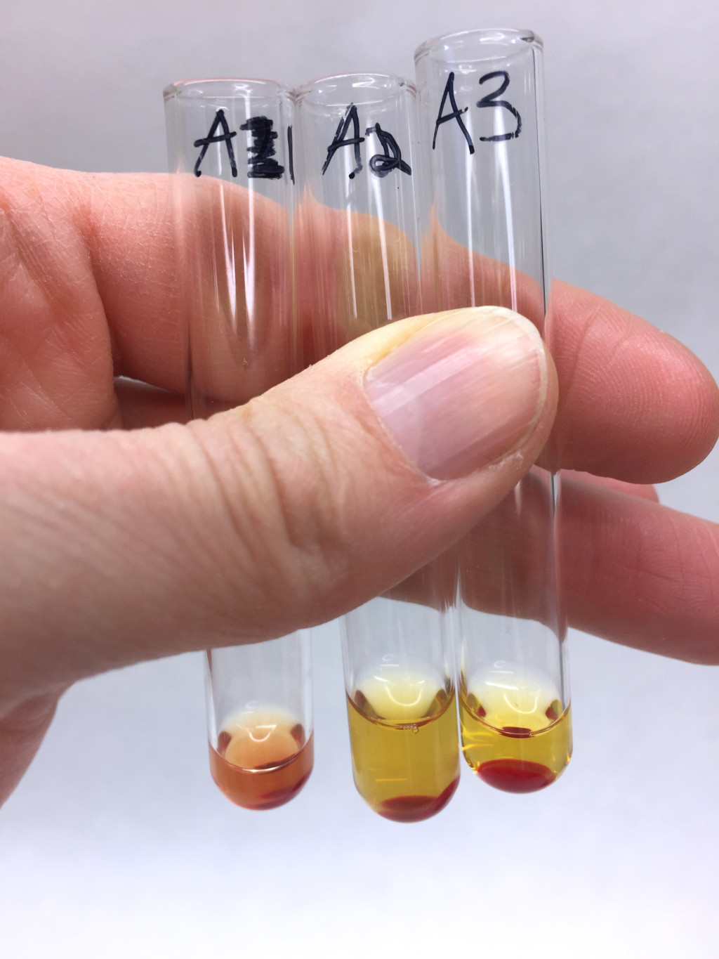 Figure 2 Haemolysis in test tube A1 is consistent with a positive Donath-Landsteiner test.