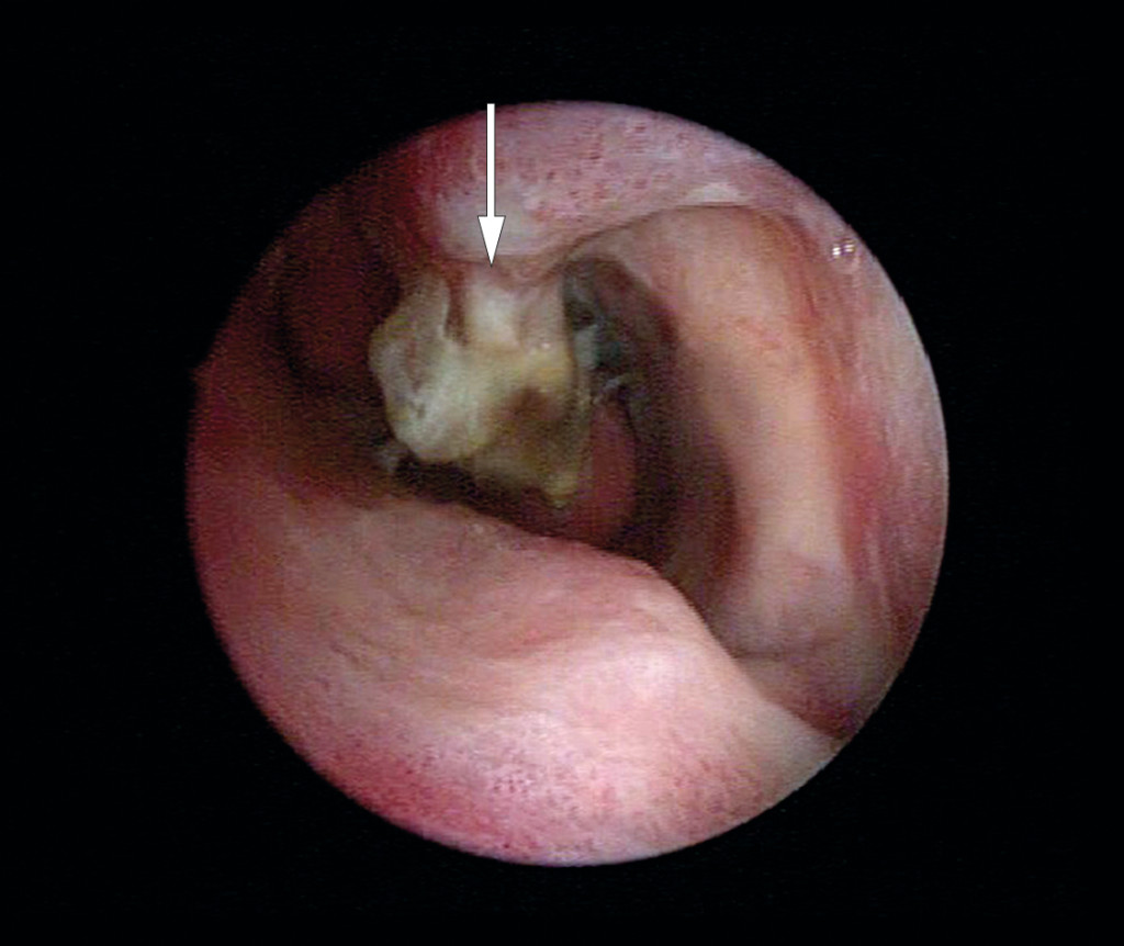 Figure 1 Patient 1 at the time of diagnosis of osteomyelitis. The image shows a pus-covered and necrotic inferior turbinate &hellip;