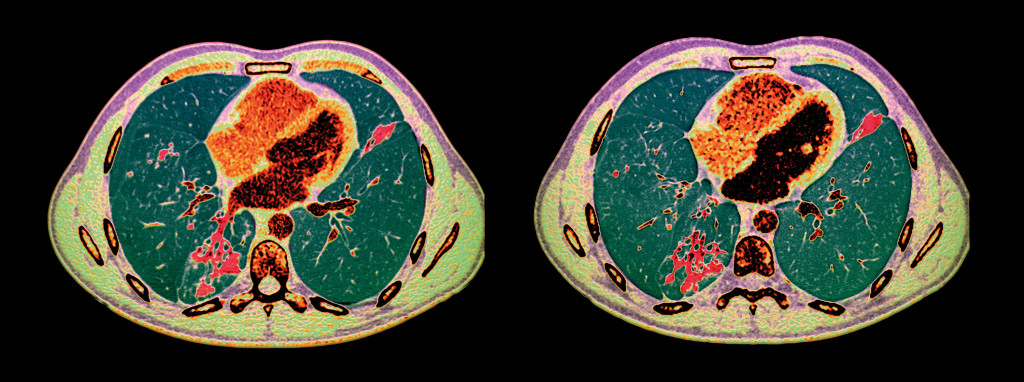 CT av lungene (m&oslash;rkegr&oslash;nt) til pasient med tuberkulose. Ber&oslash;rte omr&aring;der i r&oslash;dt. Illustrasjonsfoto: Science photo library /&hellip;