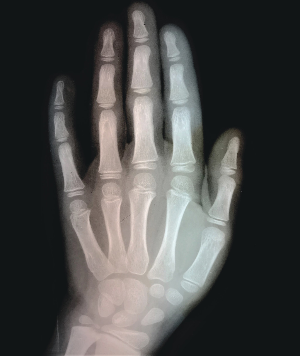 Figur 1 R&oslash;ntgenbilde av h&aring;nden til en ni&aring;ring. Fra De Schreinerske Samlinger, Universitetet i Oslo.