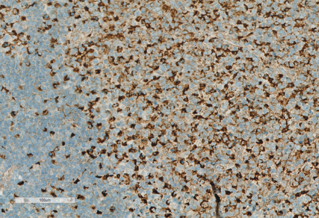 Figure 2 CD68 immunostaining, showing a clear increase in the number of histiocytic cells.