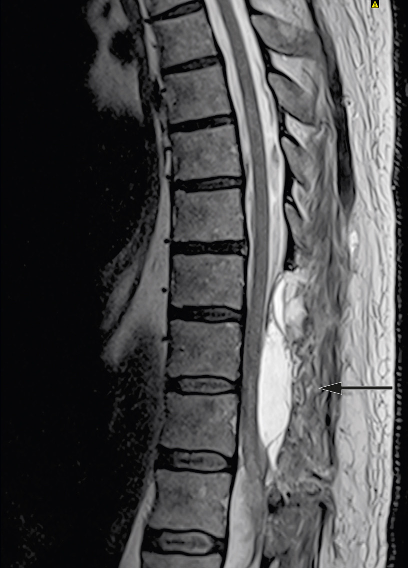Figure 3 MRI ten days after surgery: New epidural accumulation of cerebrospinal fluid with mass effect.