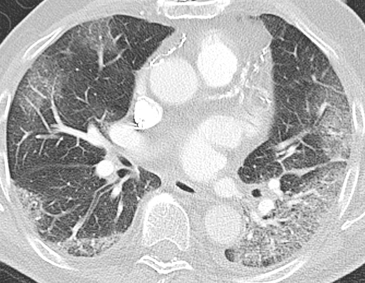 Figure 1 Pulmonary CT angiogram taken on day 5. Axial CT image with lung window shows solid ground-glass opacities in all&hellip;
