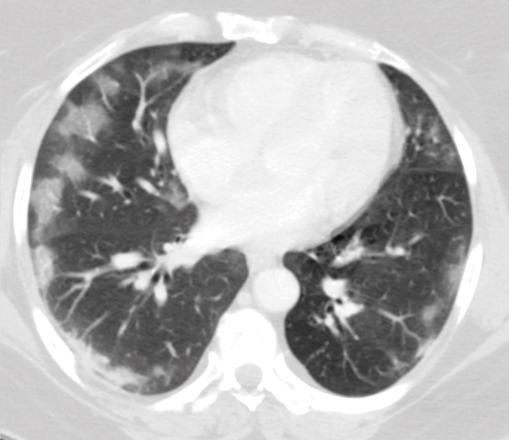 Figure 2 CT image of patient (not actual case study) with acute abdomen as an early symptom. The image shows the lower part&hellip;