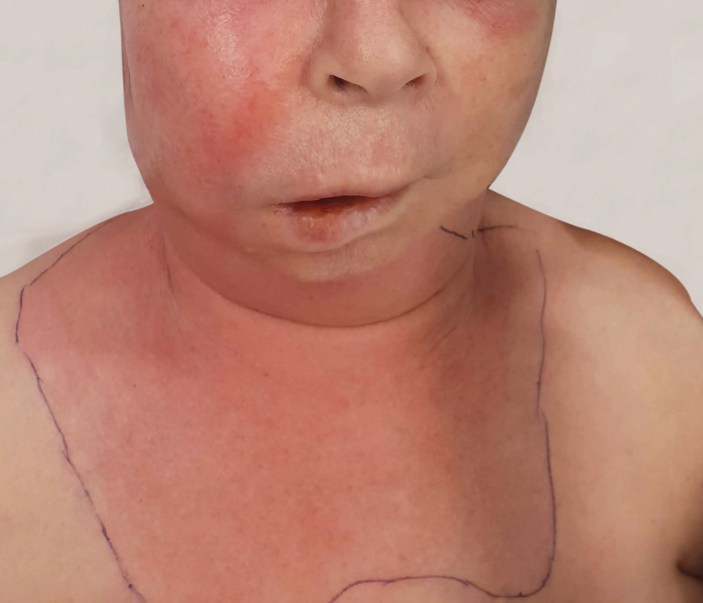 Figure 3 Necrotising soft tissue infection originating from a periapical abscess on an upper right molar.