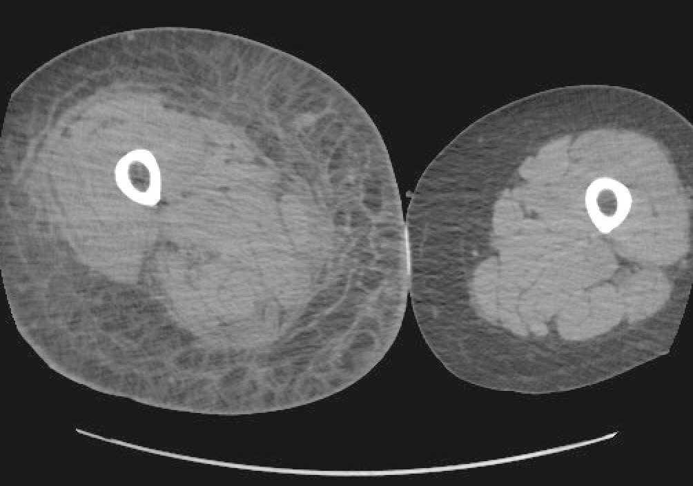 Figure 1 CT of lower extremity with subcutaneous oedema.