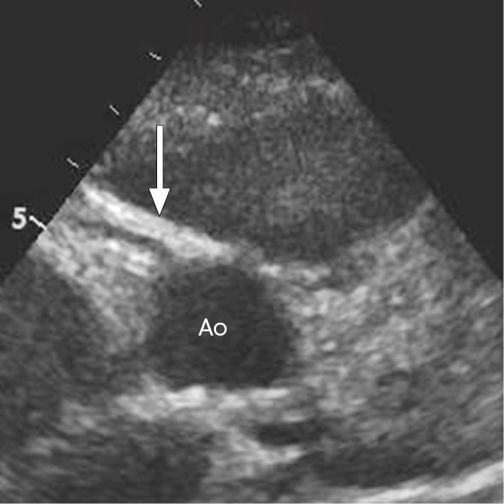 Figure 1 Echocardiogram of the aorta in cross-section (Ao) showing the exit point of the right coronary artery (arrow). The&hellip;