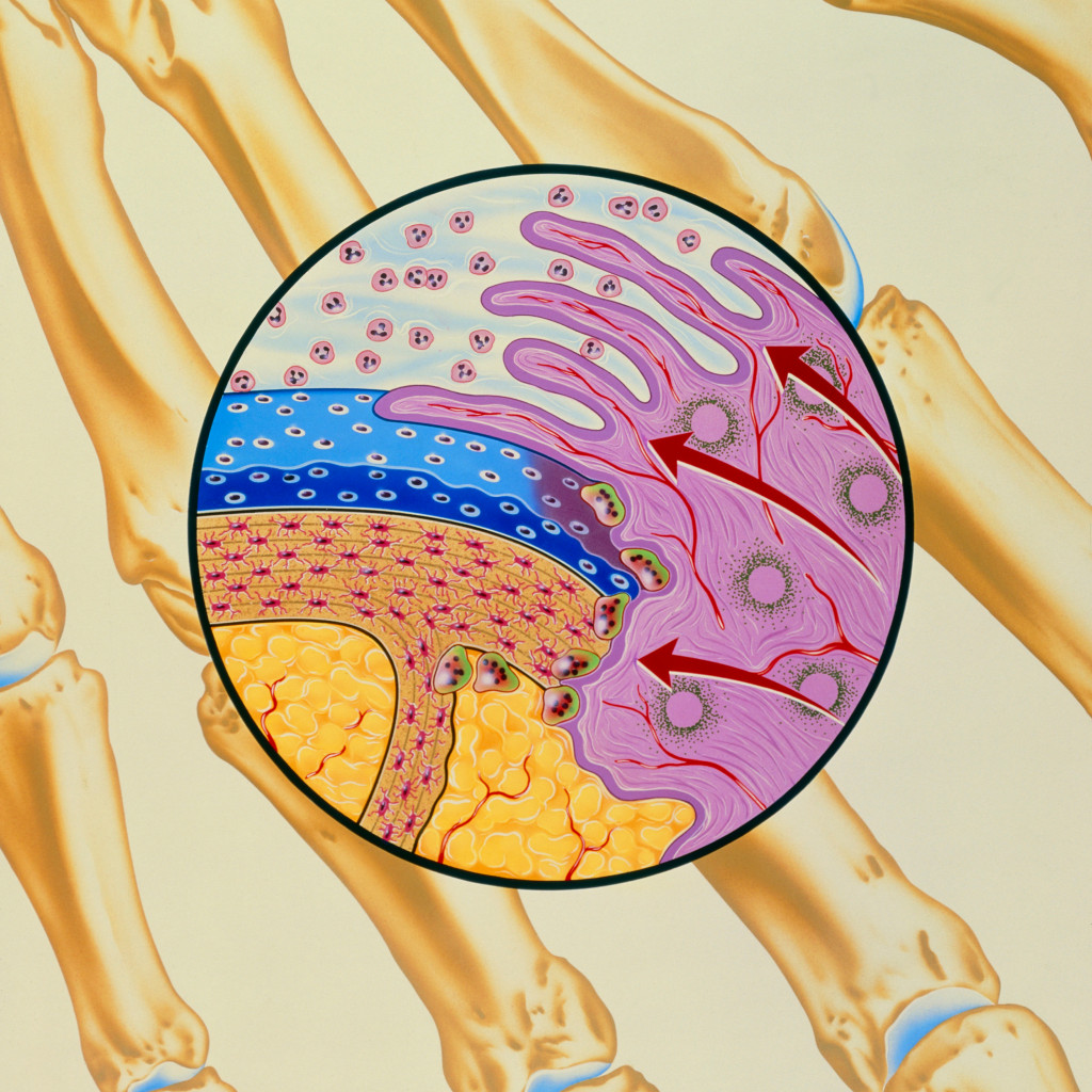Den betente synovialhinnen produserer fibr&oslash;st, vaskul&aelig;rt vev kalt pannus (lilla), som etter hvert vil dekke leddbrusken&hellip;