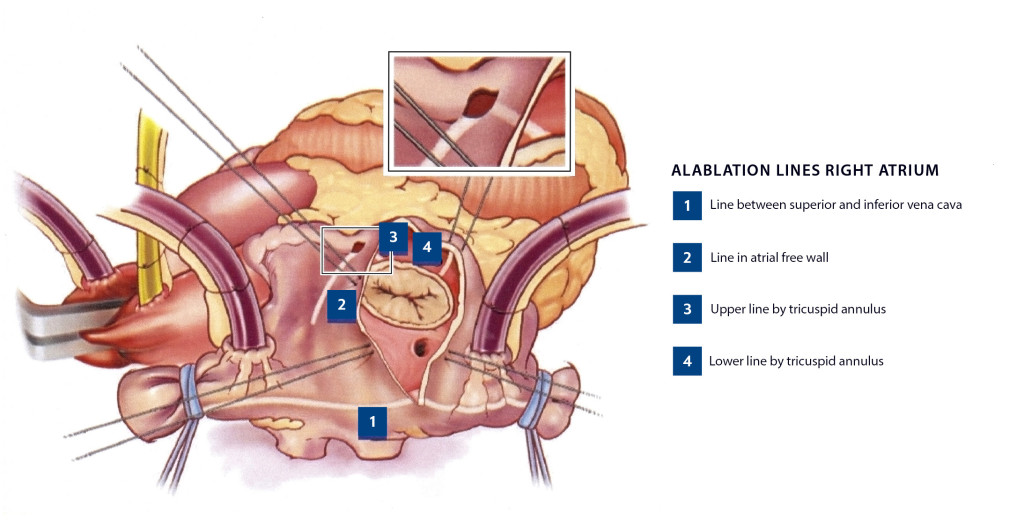 Figure 2 Ablation lines according to the CURE-AF protocol generated by means of radiofrequency ablation. The figure is&hellip;