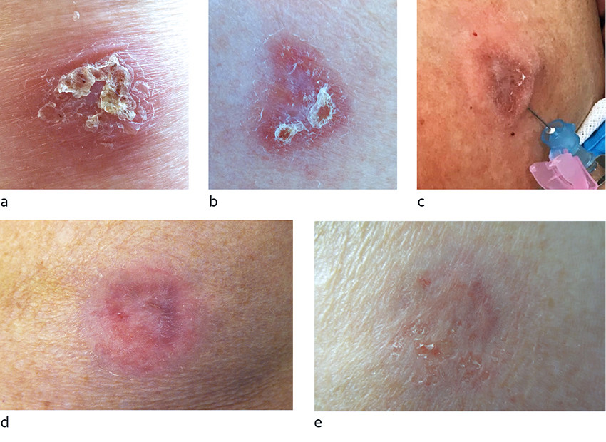Figure 2 Cutaneous leishmaniasis on the upper arm caused by L. (L.) infantum. a) prior to liposomal amphotericin B, b) seven&hellip;