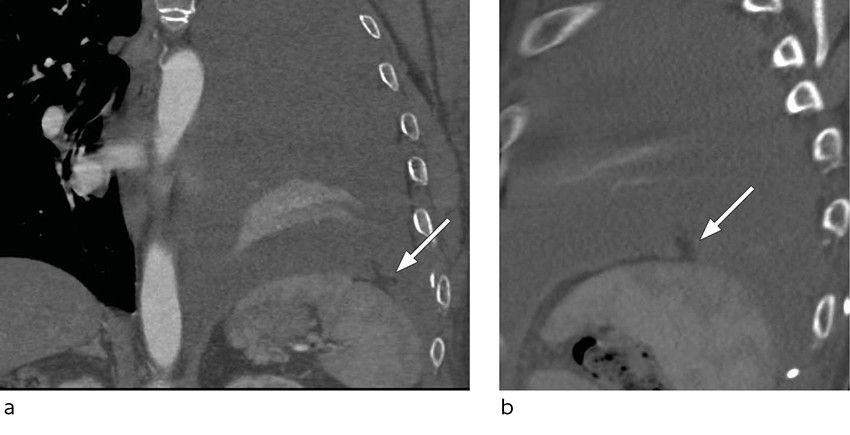 Figure 2 Chest CT with intravenous contrast, in coronal (a) and sagittal (b) plane, with a small defect in the left side of&hellip;
