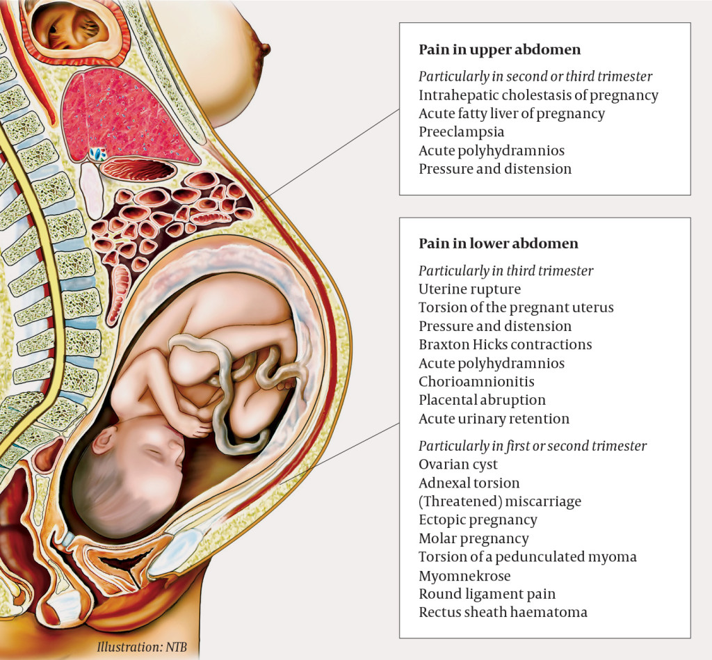 Figure 1 Gynaecological diagnoses to consider in cases of acute abdomen in pregnancy. The risk assessment will depend on&hellip;
