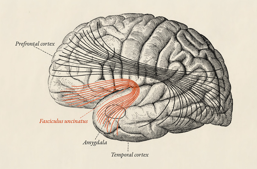 Figure 2 The uncinate fasciculus is the last neural pathway to be myelinated, a process which is not complete until the&hellip;