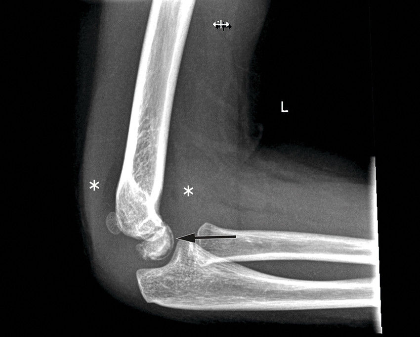 P&aring; r&oslash;ntgenbildet samsvarer oppklaringslinjen (markert med sort pil) med flere sm&aring; gassbobler p&aring; samme sted p&aring; CT-bildet &hellip;
