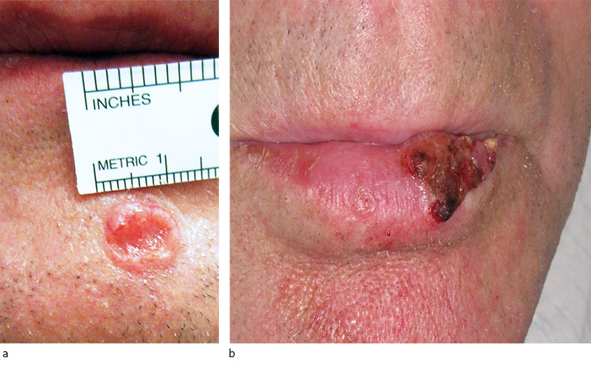 Figur 1 Basalcellekarsinom (a) og kutant plateepitelkarsinom (b). Foto: Ingrid Roscher