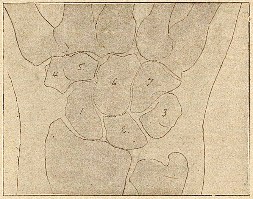 Fig. I Normal venstre haand. 1 = os scaphoideum, 2 = os triquetrum, 4&ndash;5 = os multangulum majus og minus, 6 = os capitatum, 7&hellip;