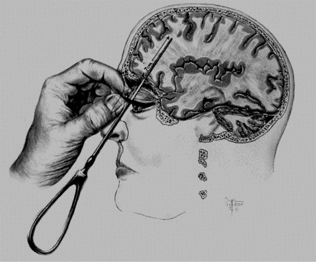 Figur 2 Tegning fra boken &laquo;Psychosurgery&raquo; av Freeman and Watts, 1950, som viser hvordan prefrontal lobotomy ble utf&oslash;rt (2)&hellip;