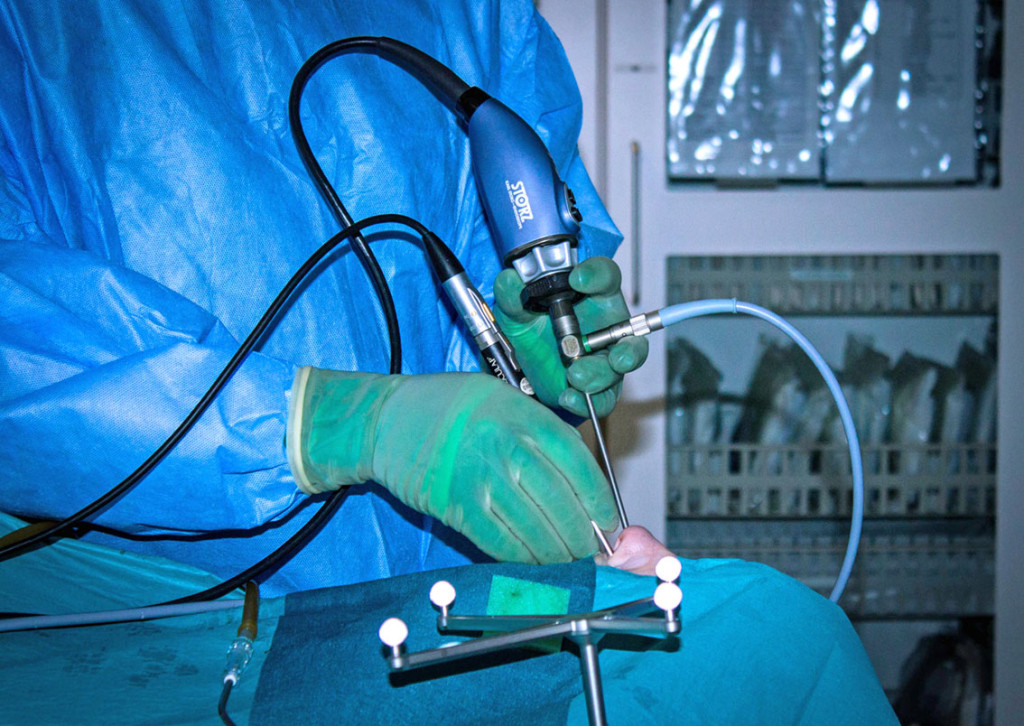 Figure 2 Endoscopic two-hands technique. The surgeon controls the camera with their left hand and operates with their right&hellip;