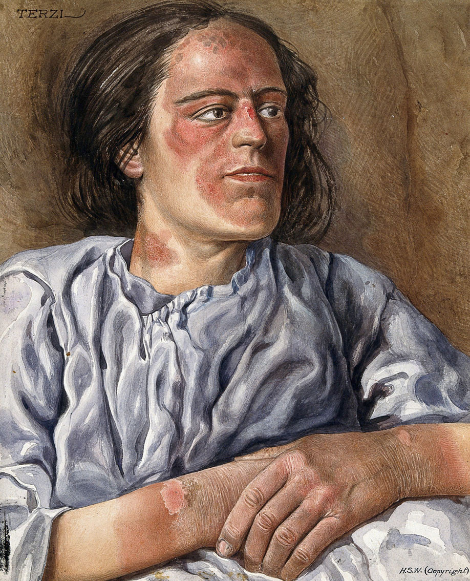En kvinne med kronisk pellagra. Maleri av Amedeo John Engel Terzi (1872&ndash;1956), ca. 1925. Wellcome Collection / Public Domain