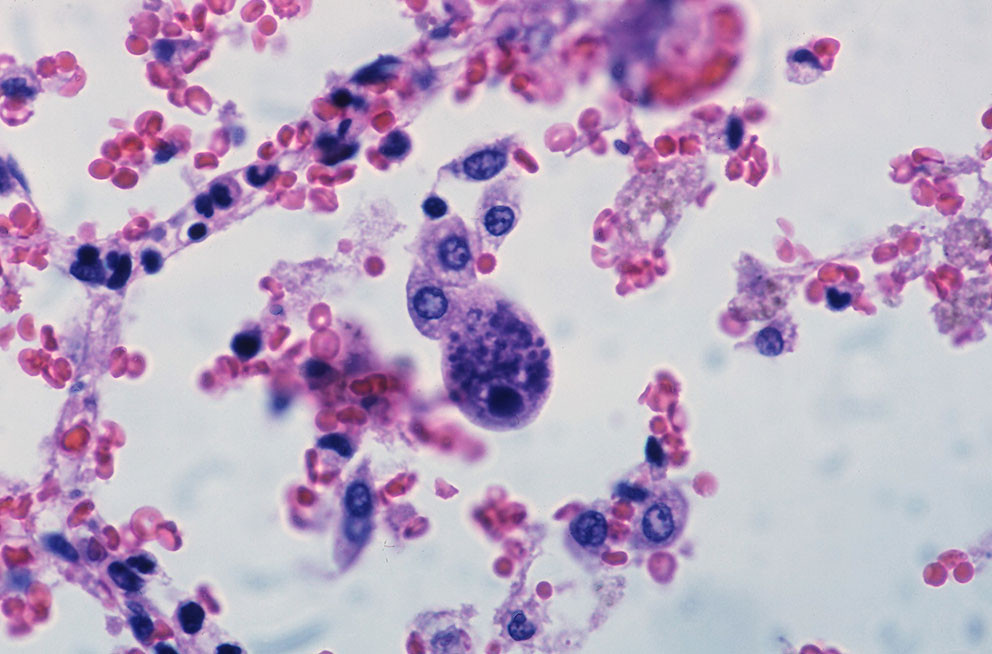 Cytomegalovirusinfeksjon. Foto: Yale Rosen, CC BY-SA 2.0
